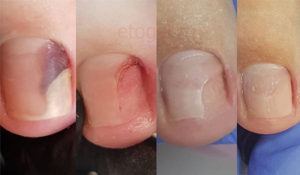 Травматический онихолизис ногтей